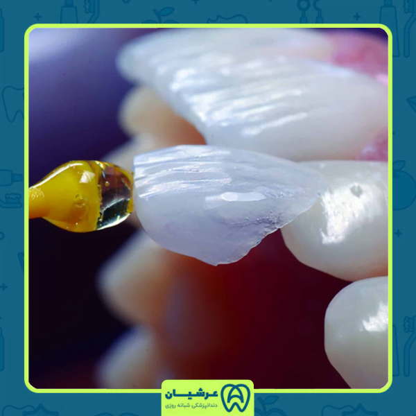 اصلاح کجی دندان با استفاده از لمینت‌های دندانی