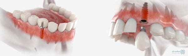 ایمپلنت دندان کلینیک عرشیان