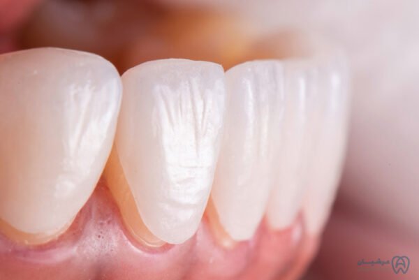 لمینیت دندان کلینیک عرشیان