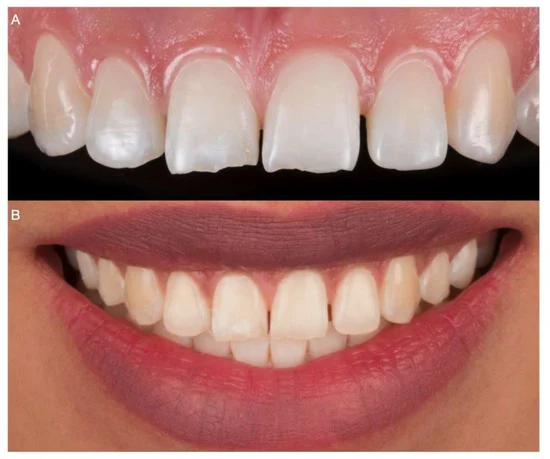 اصلاح کجی دندان