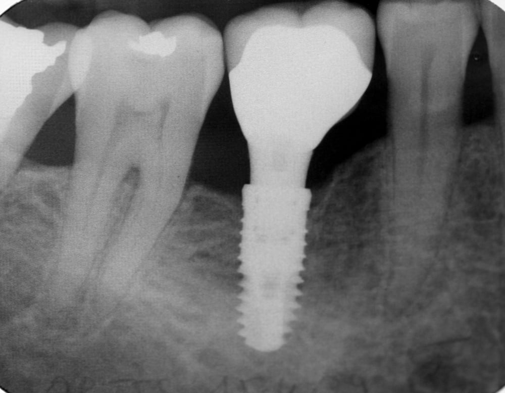 ایمپلنت دندان آسیاب