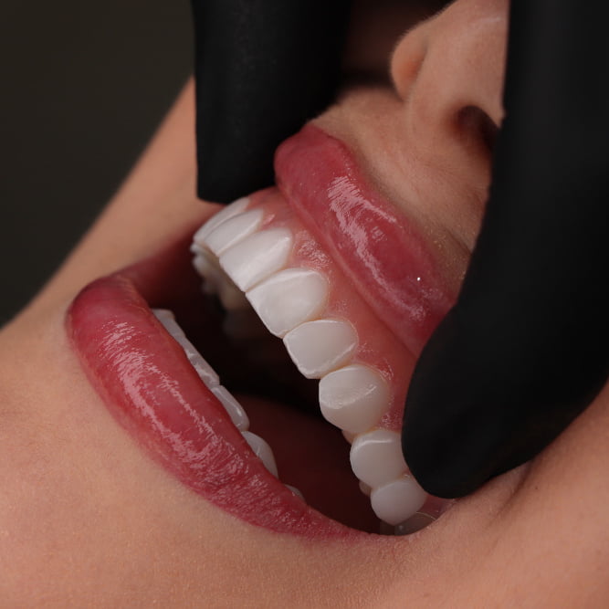 ایا کامپوزیت دندان باعث پوسیدگی میشود