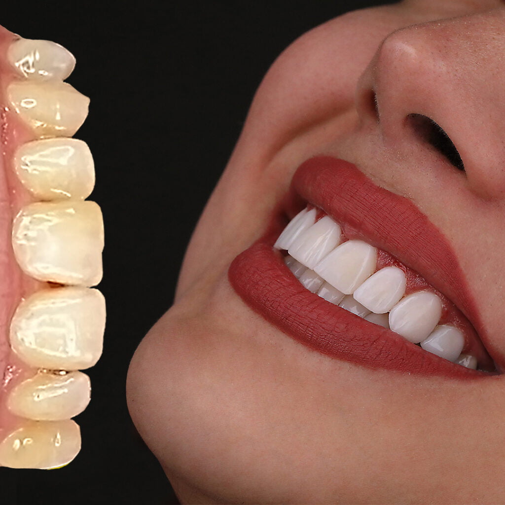 ایا کامپوزیت دندان باعث پوسیدگی می شود