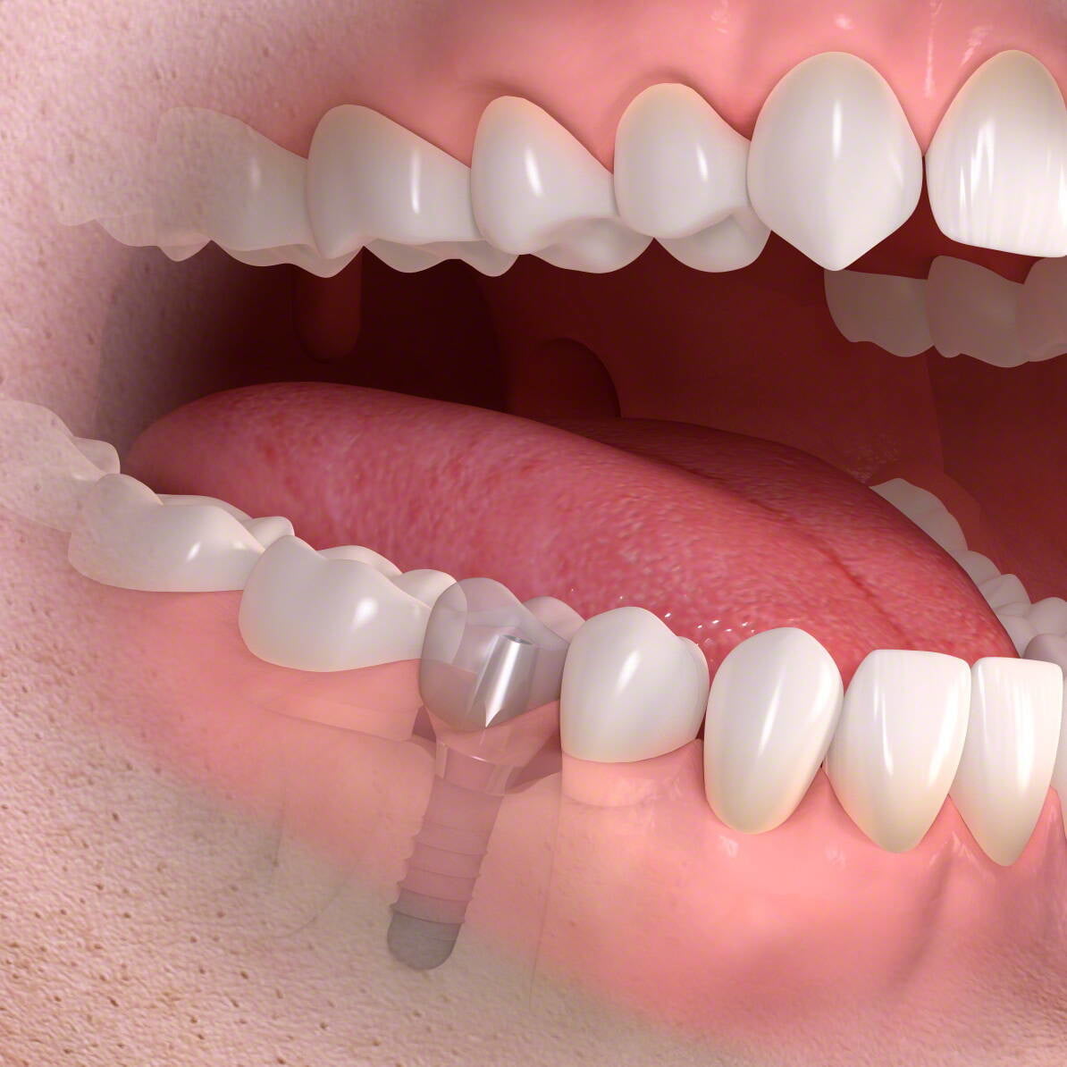 ایمپلنت دندان اقساطی