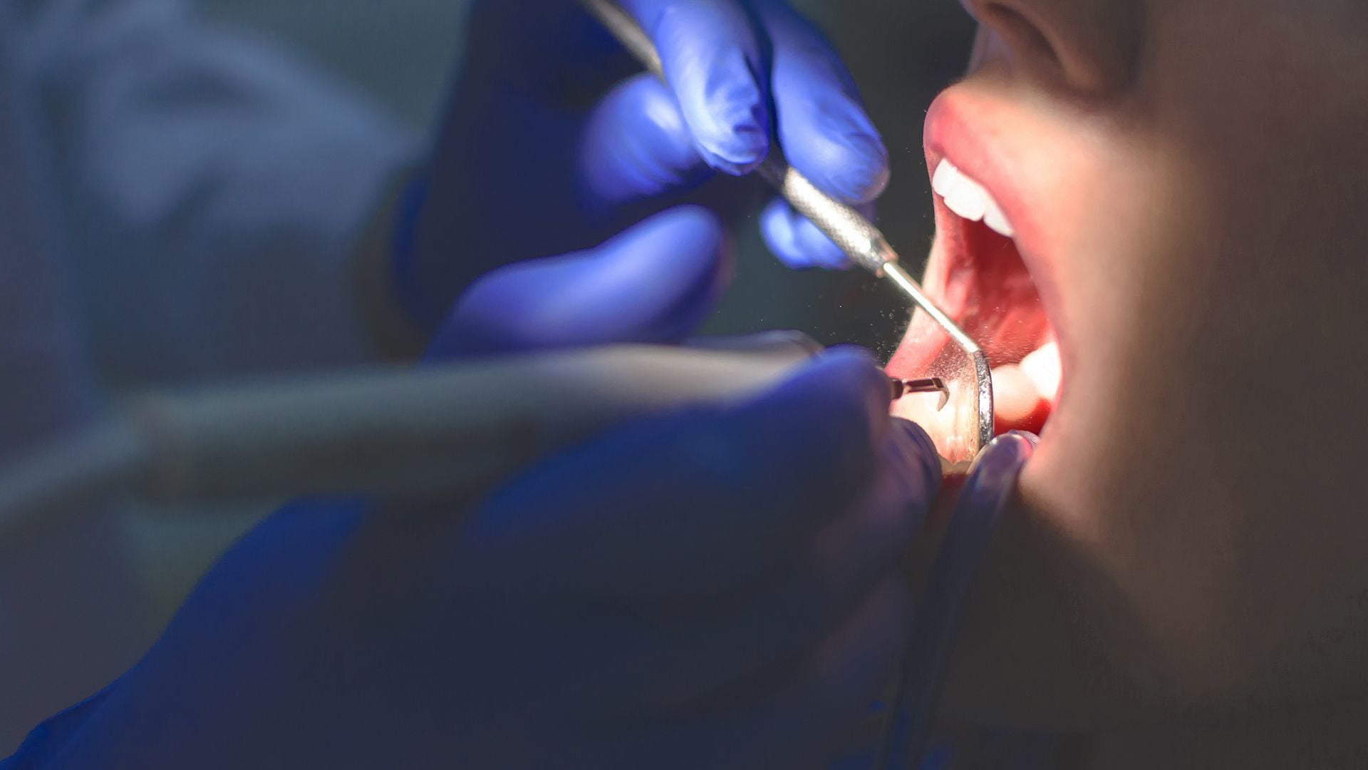 علائم به عصب رسیدن پوسیدگی دندان 
