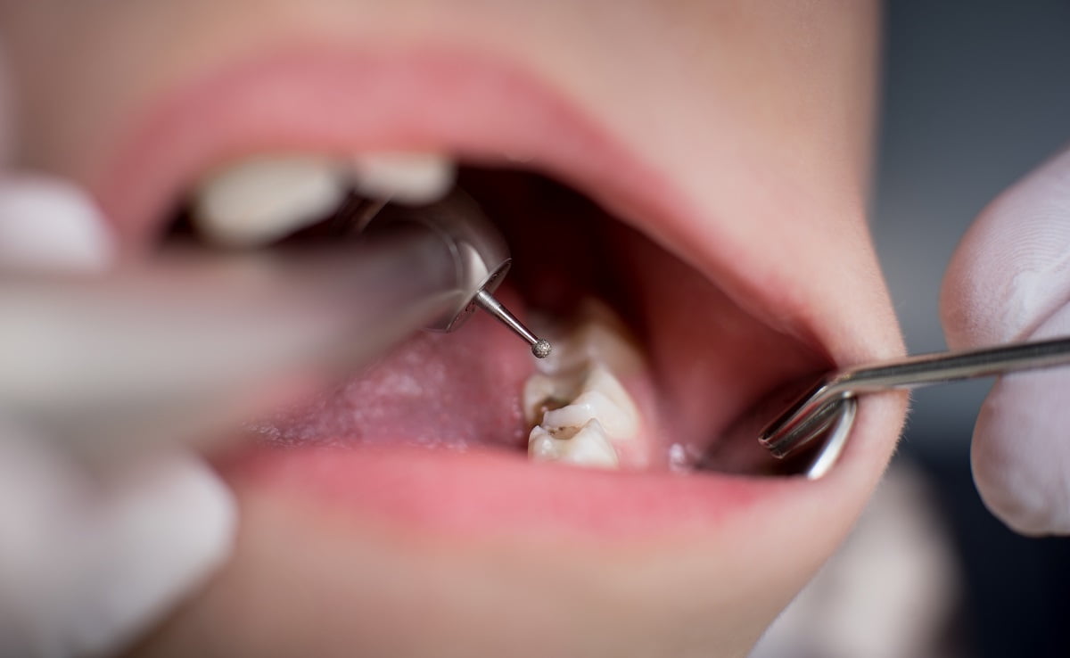 علائم به عصب رسیدن پوسیدگی دندان 