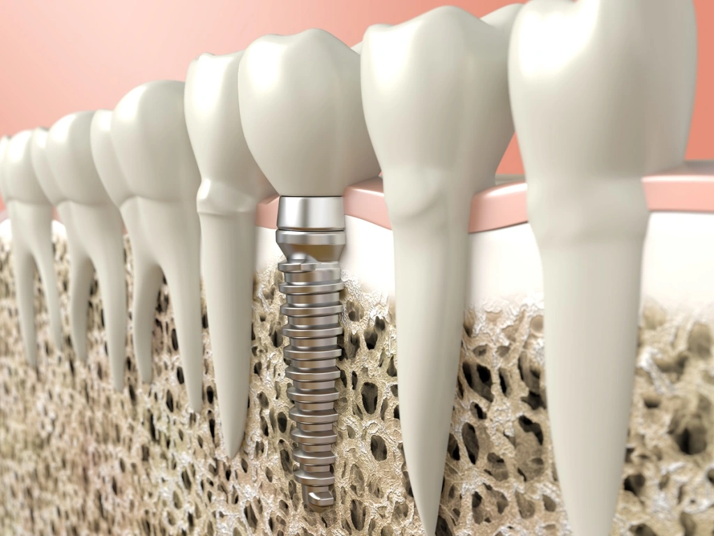 چه کسانی در ایمپلنت دندان نیاز به پودر استخوان دارند؟