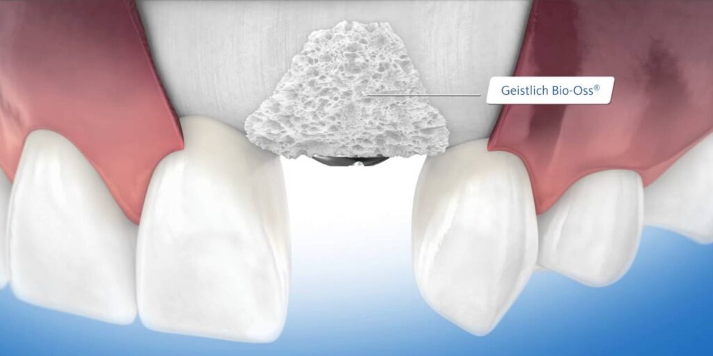 چه کسانی در ایمپلنت دندان نیاز به پودر استخوان دارند؟ 