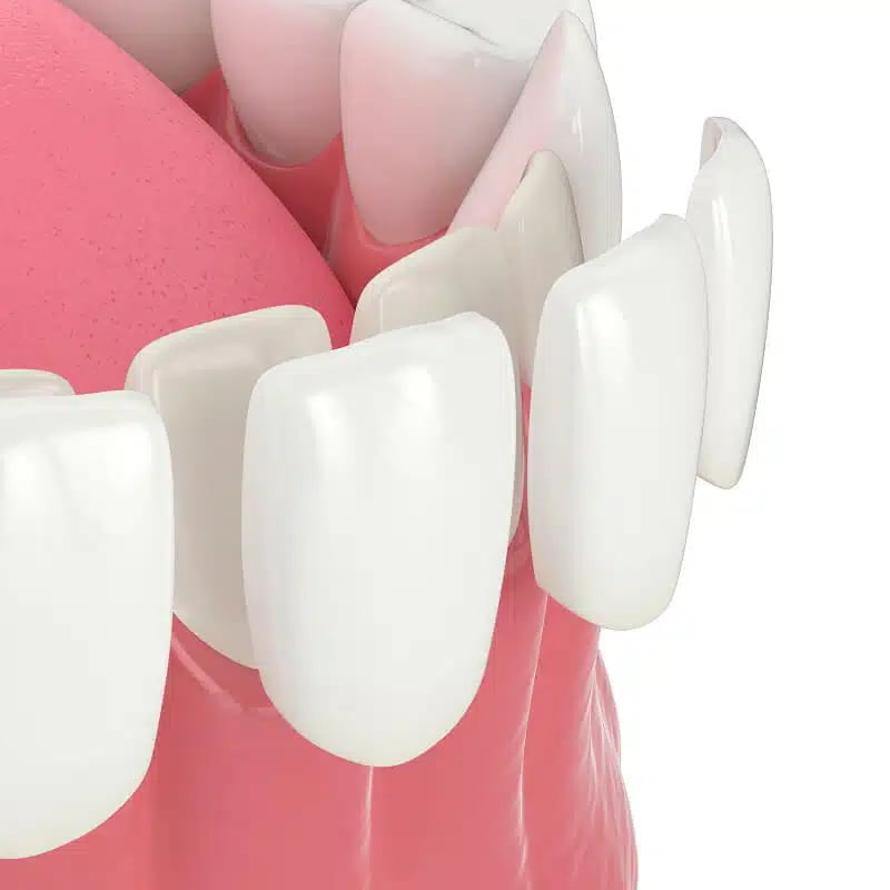آیا کامپوزیت برای دندان ضرر دارد؟