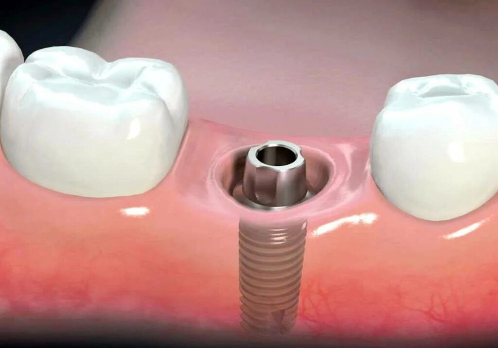 ایمپلنت دندان دیجیتال