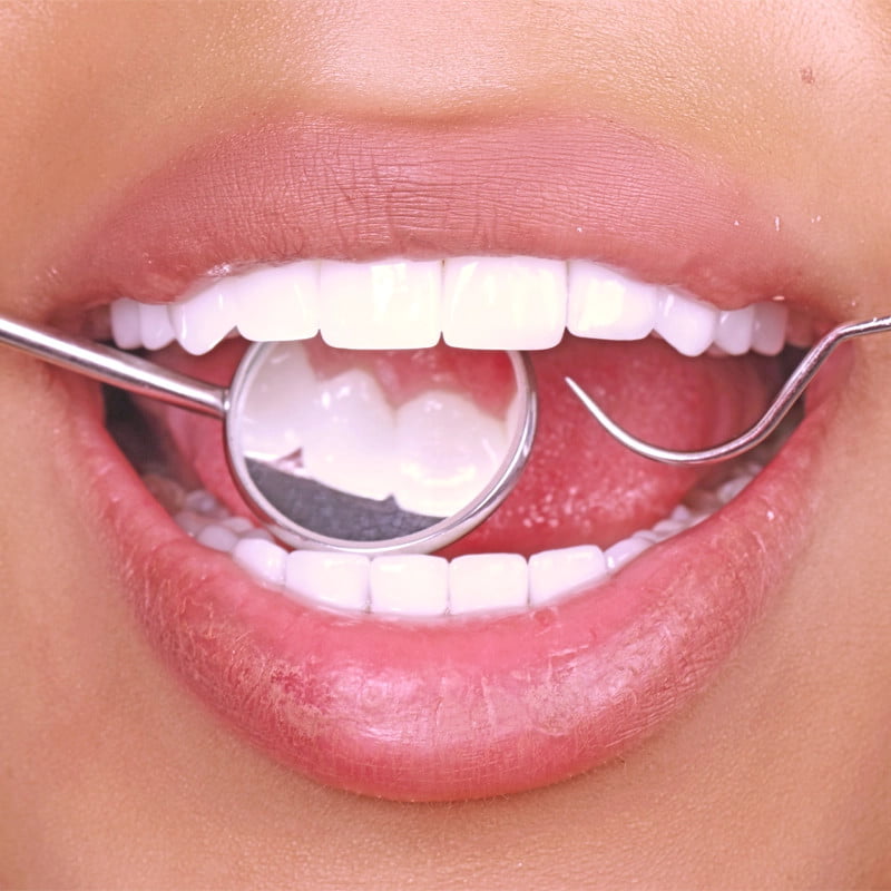 آیا ایمپلنت دندان عمری است؟