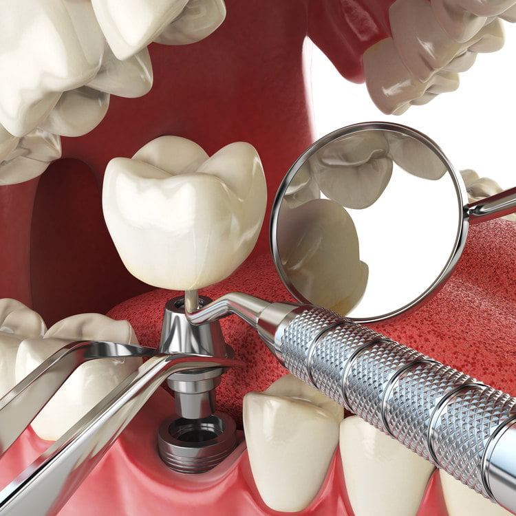8 مورد از عوارض ایمپلنت دندان