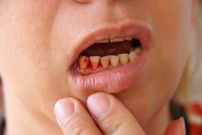 عوارض ایمپلنت دندان ۲