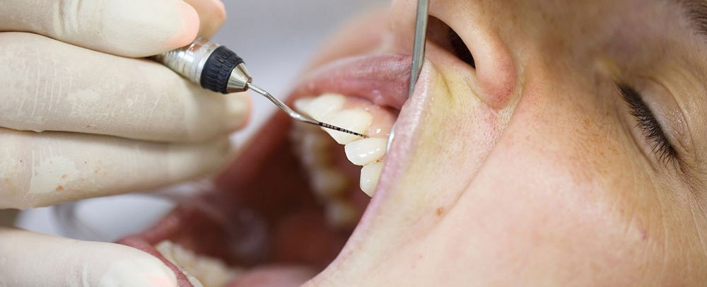 بیماری های عفونی دهان و دندان 3