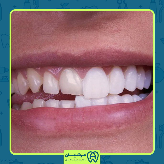 هر واحد لمینت چند دندان است؟
